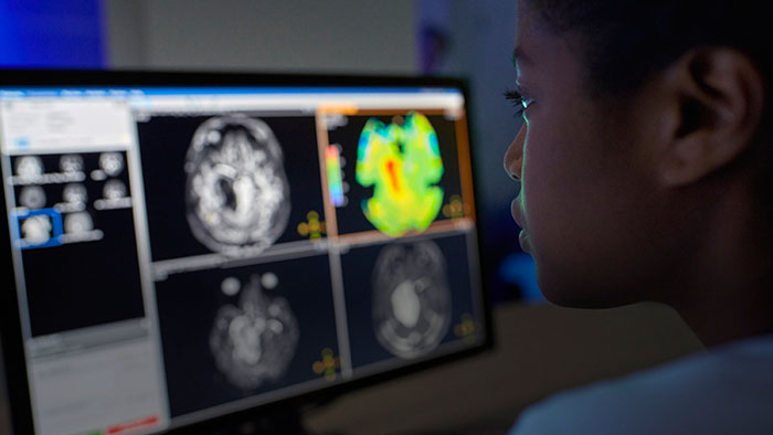 Enhancing brain tumor MRI with APT weighted imaging