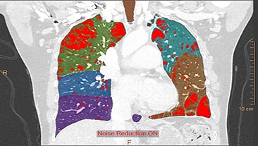 ct copd